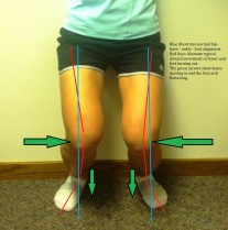 Correcting common movement dysfunctions, such as knee adduction, tibial external rotation, and foot external rotation can go a long way in preventing Achilles tendinopathy. 
